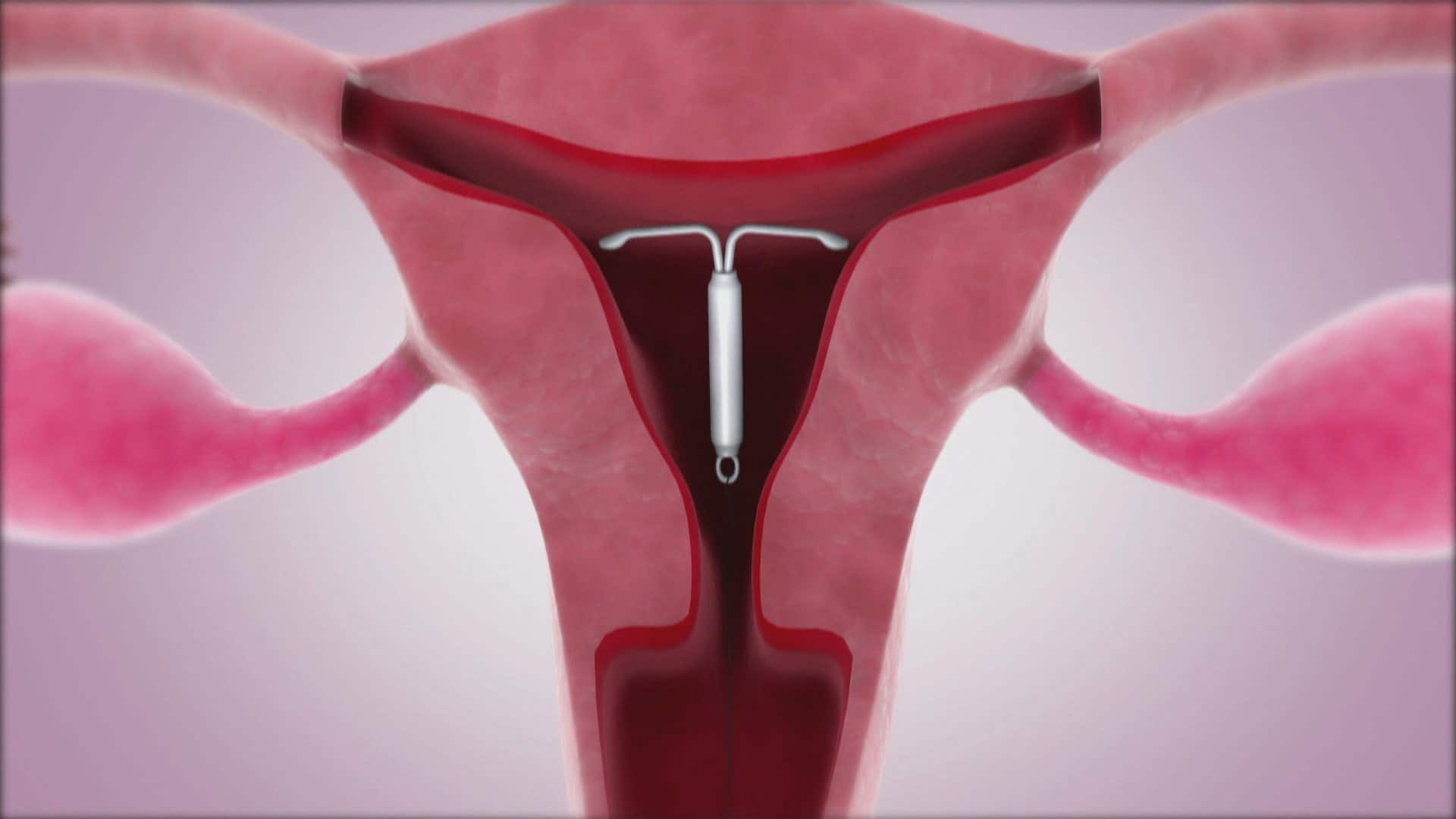 Iud In Uterus Diagram