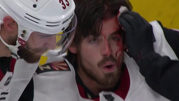 Garland S Bloody Effort Pushes Coyotes Over Oilers Cbc Sports