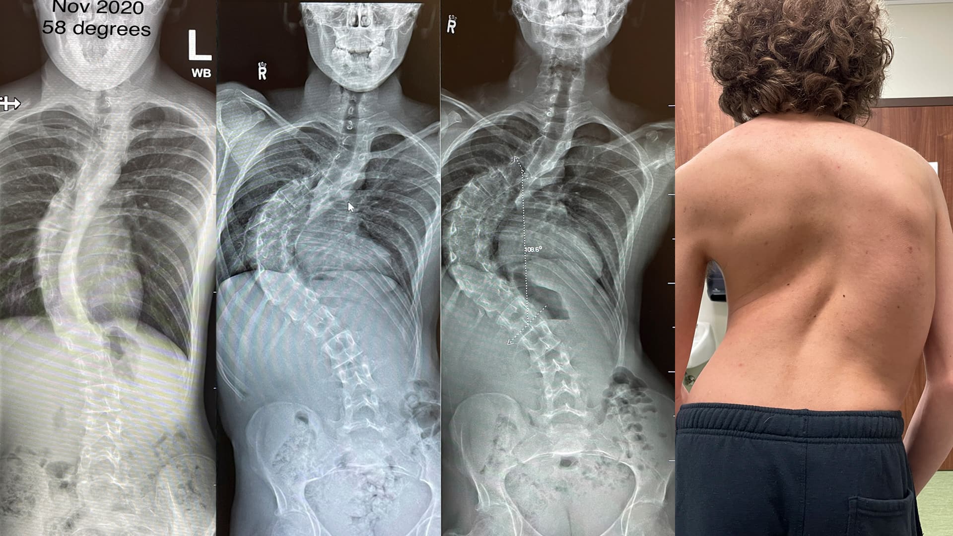 Severe Scoliosis Before And After 9858